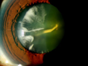 Cortical and nuclear sclerotic cataract