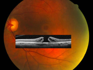 Macular hole visible with fundus photo and OCT