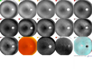 Annidis multispectral imaging of the retina