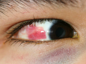 Red eye from subconjunctival hemorrhage in child